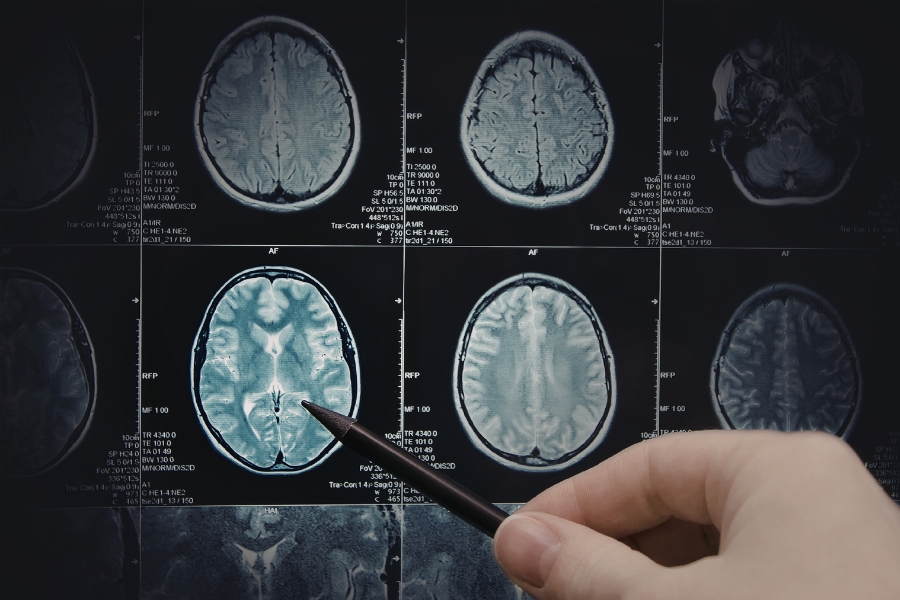 neuroplastyczność mózgu